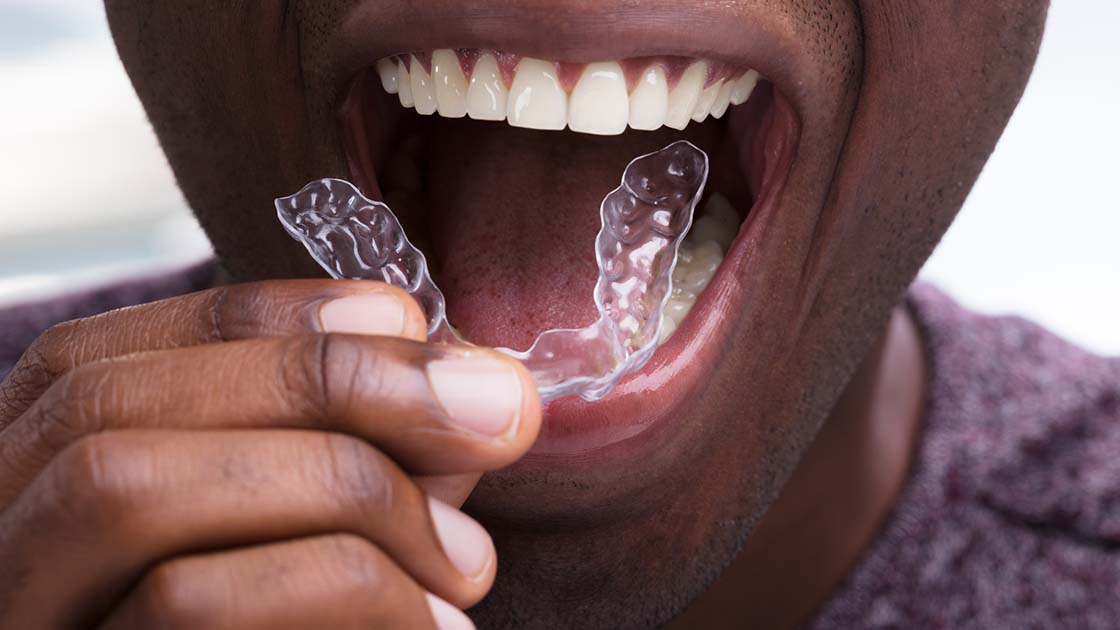 Clear Aligners