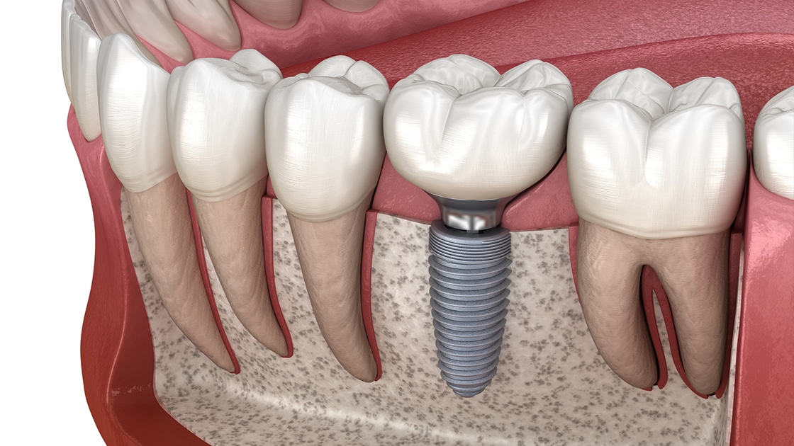 Dental Implants Graphic